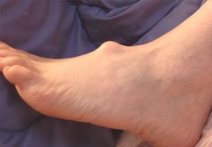 ganglion